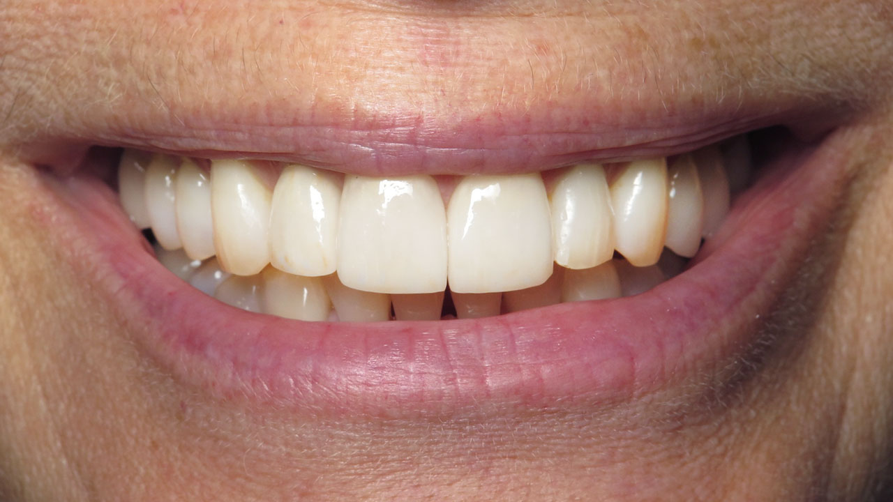 Porcelain Veneers Dentist West Michigan After