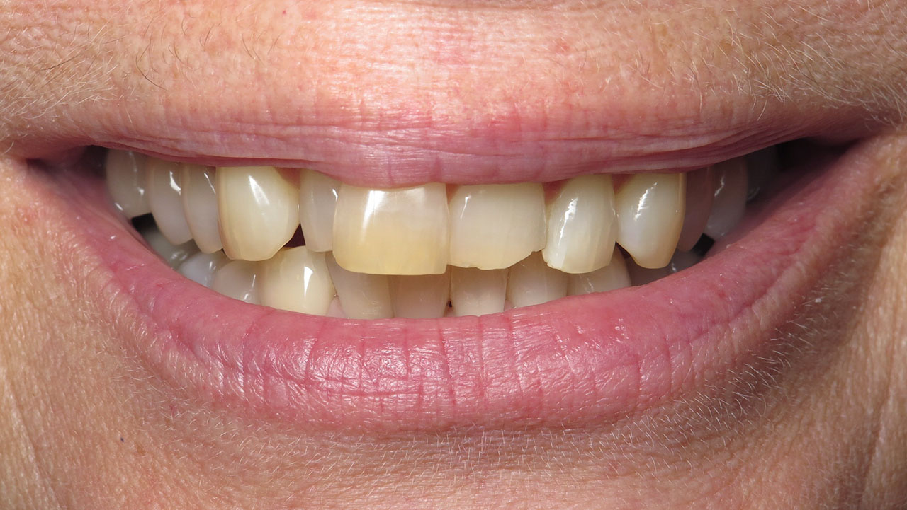 Porcelain Veneers Dentist West Michigan Before