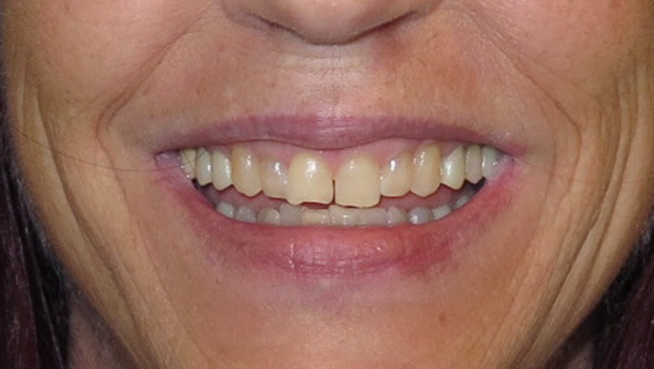Replace Silver Fillings Smile After Grandville Mi