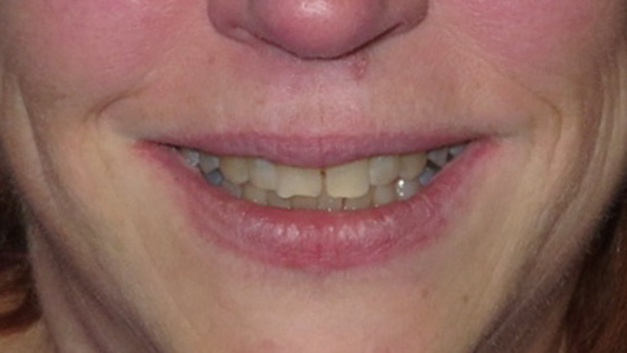Replace Silver Fillings Smile Before Grandville Mi