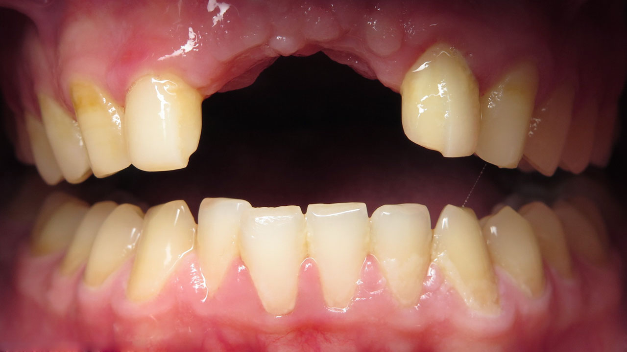 Severe Front Tooth Trauma Retracted Before Grandville Mi
