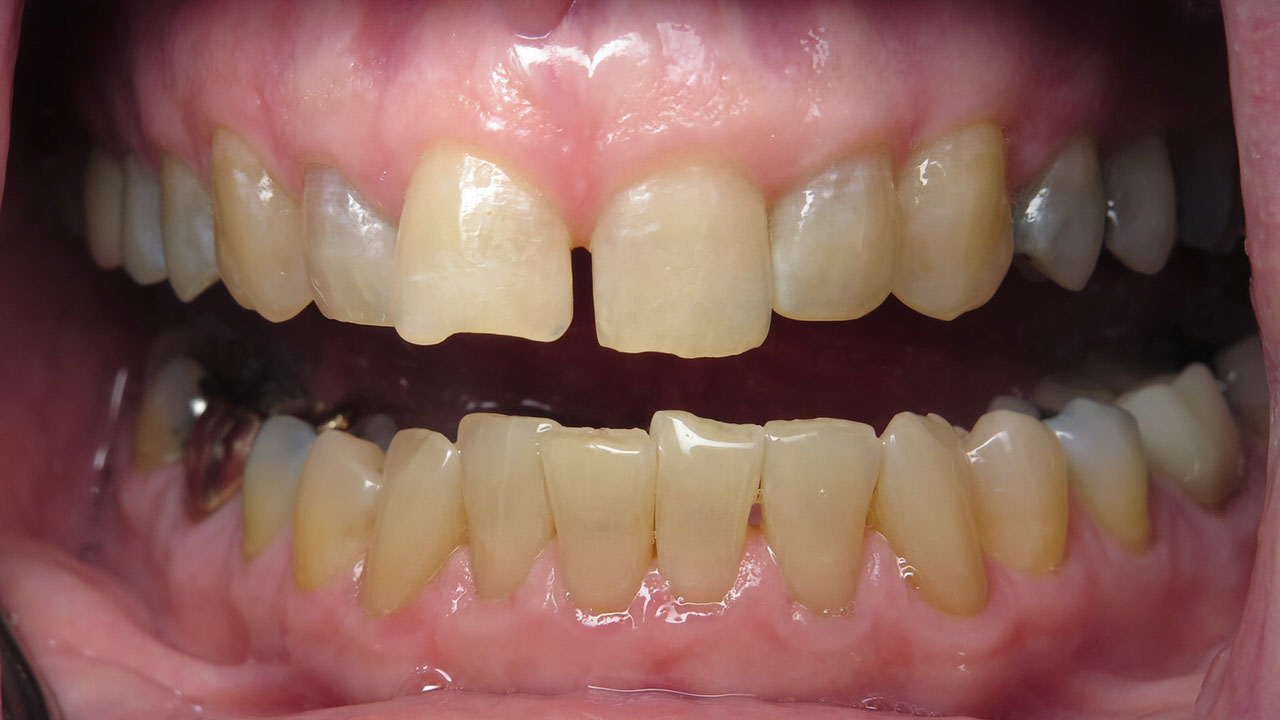 Silver Fillings And Old Restorations Retracted Before Grandville Mi