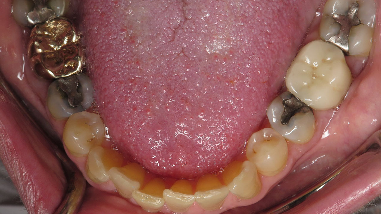 Silver Fillings Lower Teeth Before Grandville Mi