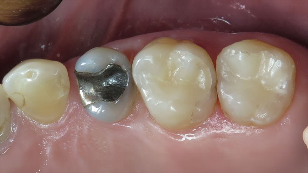 Silver Fillings Replacement After Grandville Mi