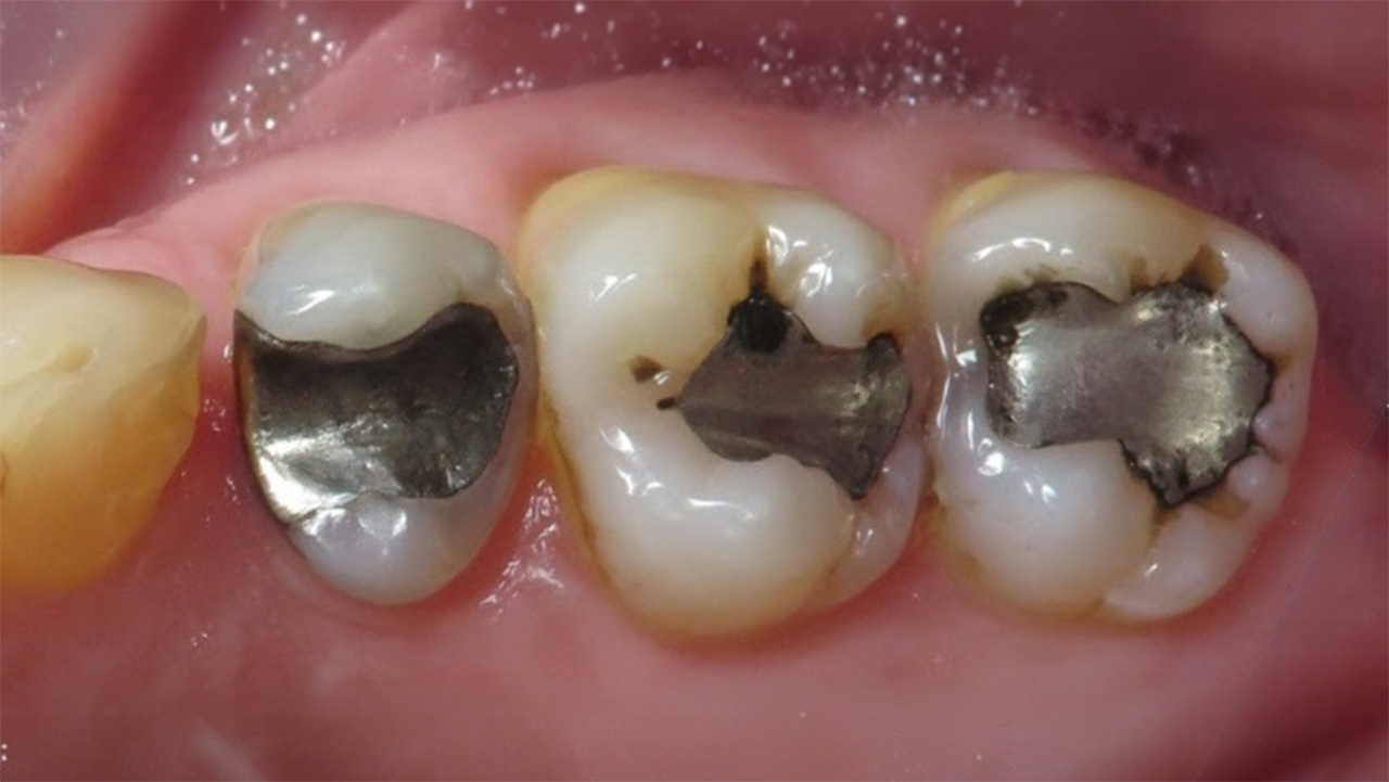 Silver Fillings Replacement Before Grandville Mi