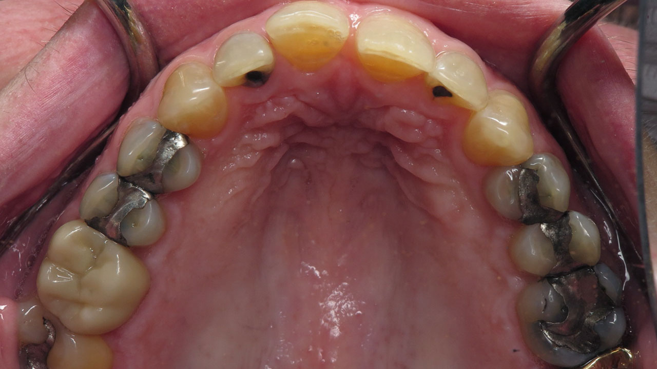 Silver Fillings Upper Teeth Before Grandville Mi