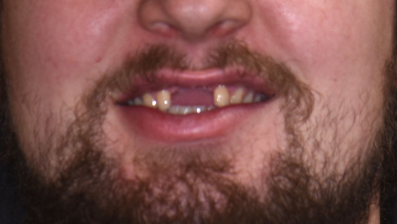 Traumatic Front Tooth Loss Work Accident Smile Before Grandville Mi
