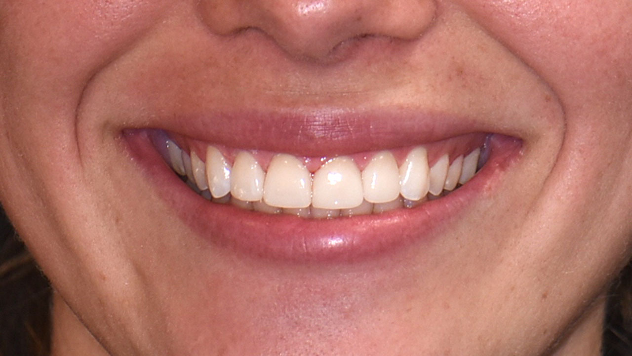 West Michigan Dental Crown Dentist After