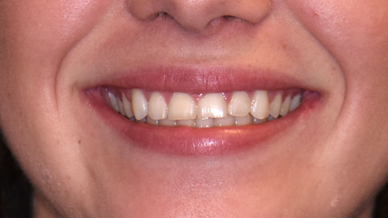 West Michigan Dental Crown Dentist Before