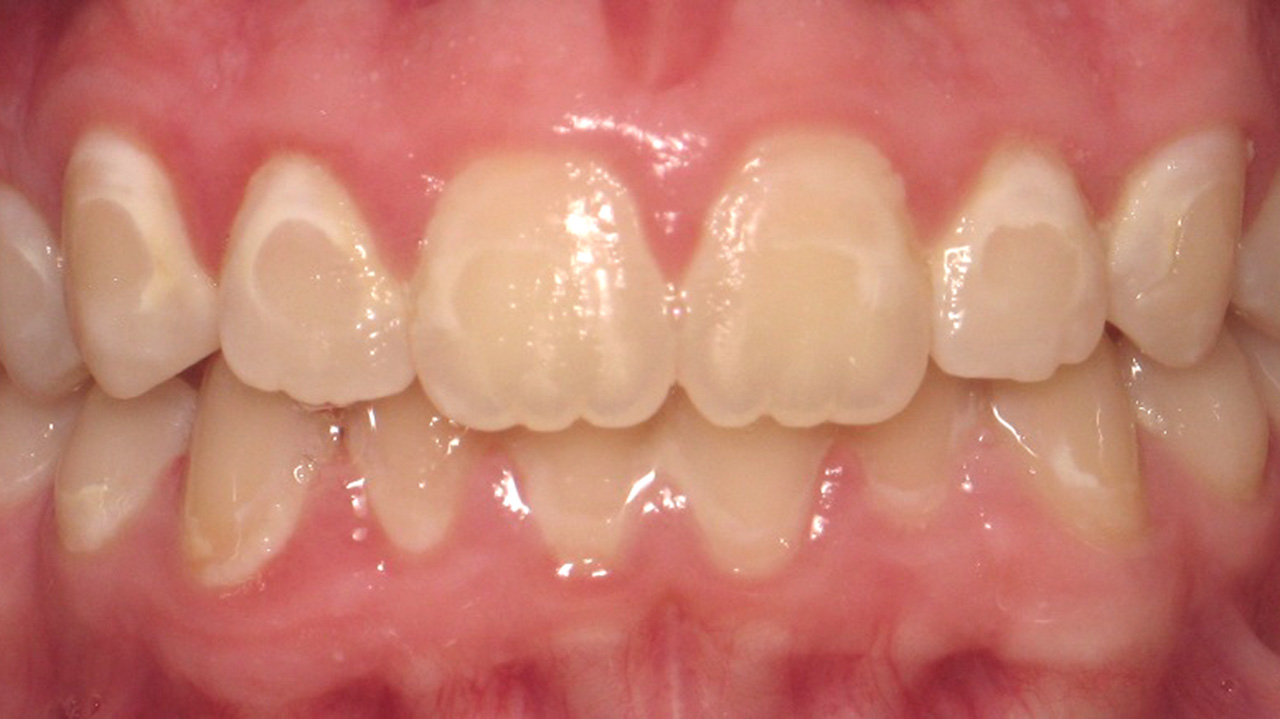 White Spot Enamel After Microabrasion Grandville Mi
