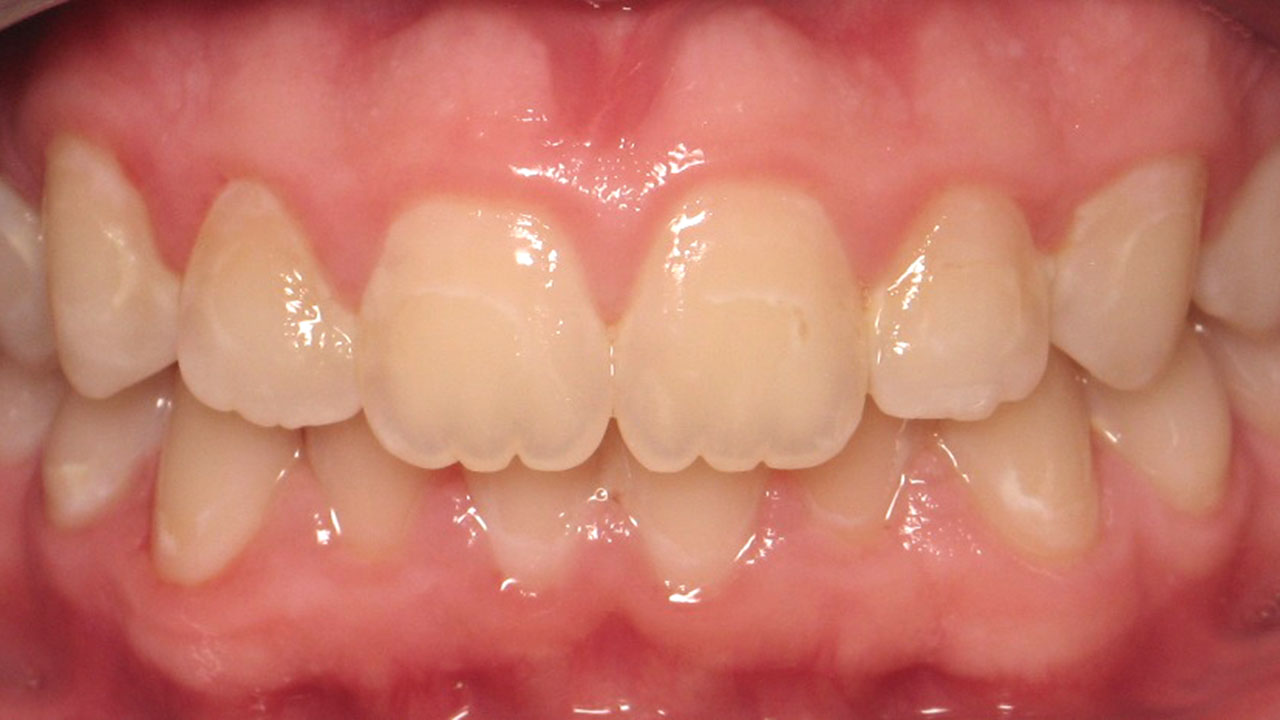 White Spot Enamel Before Microabrasion Grandville Mi